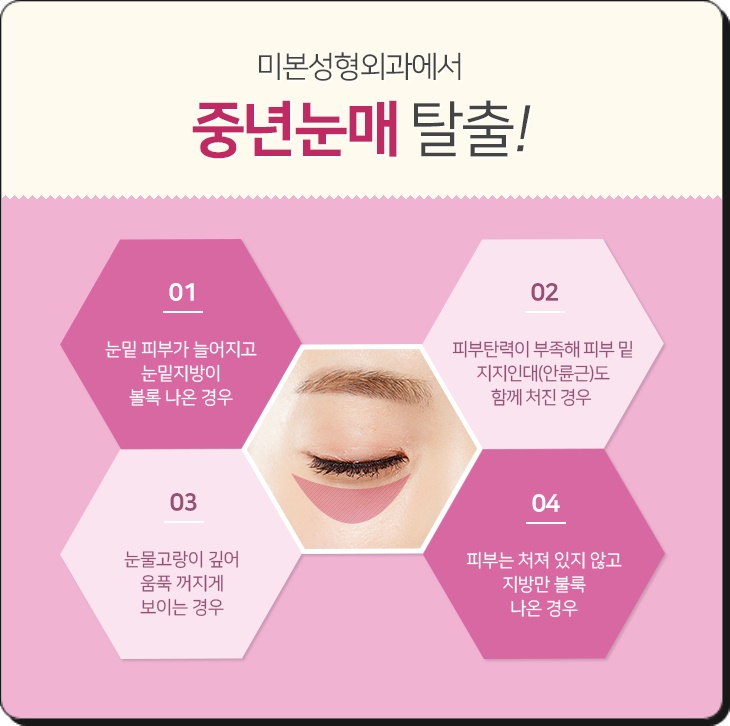 미본 이미지