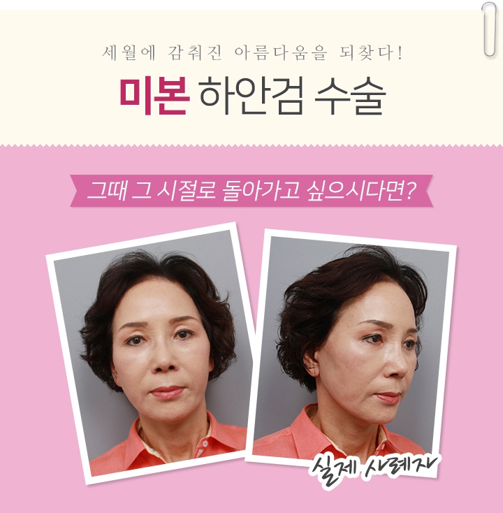 미본 이미지