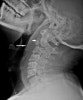 경추 골절(Fractures of the Cervical spine) : 교통사고 후 의식을 잃은 환자에서 경추가 부러졌어요 ...