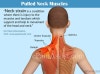 Cervical Strain cervical-strain
