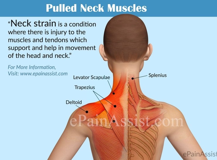 cervical-strain