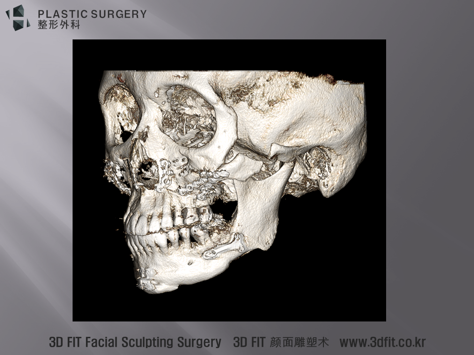 이환자의 경우 좌측 광대의 골결손과 변위가 함께 관찰되는 경우 입니다. 이 경우 재절골 및 뼈이동 & 재고정 결손부위 보충 이 모두 필요합니다.