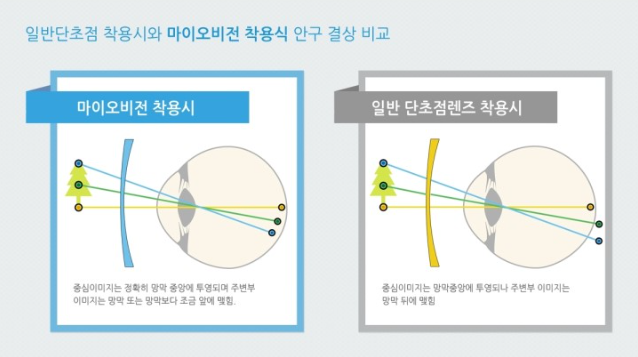 엠씨렌즈 이미지