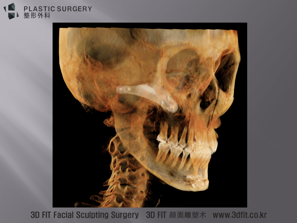 결손부위를 정확히 메꾸고 있는 3DFit Implate 티타늄 보형물의 모습입니다.