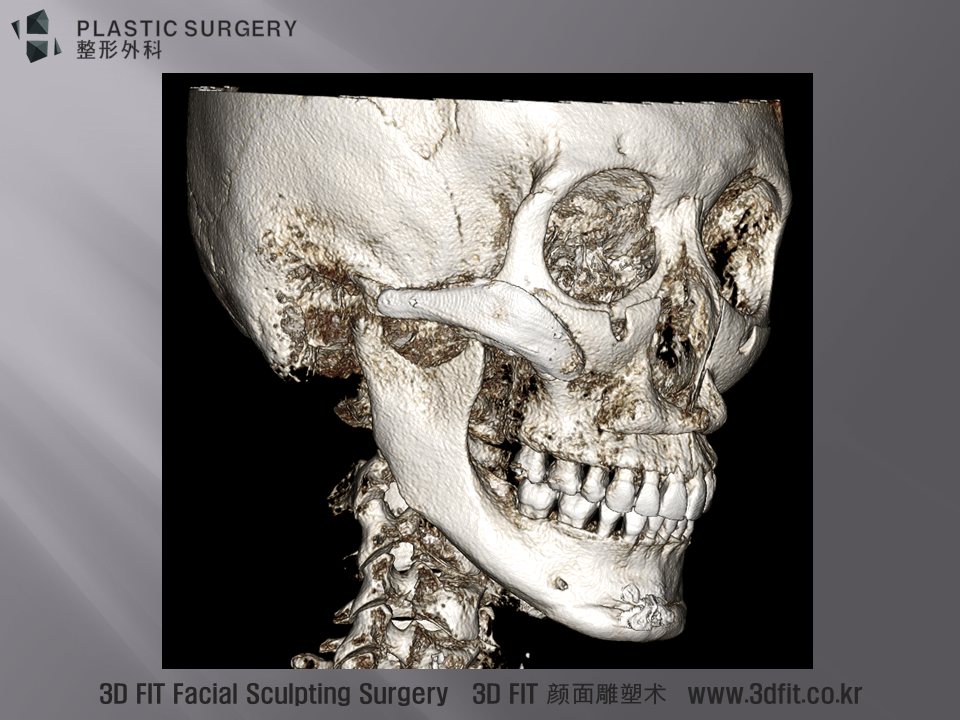 3DFit implate 삽입후의 사면 모습입니다.