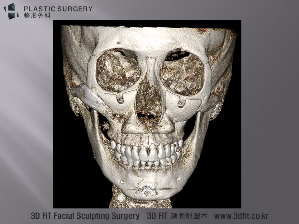 3DFit Implate 보형물 삽입후 정면 모습입니다.