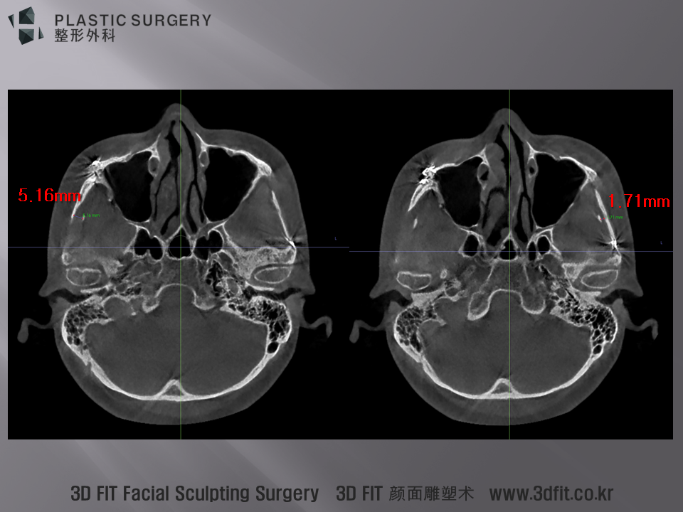 Axial image 에서 이 둘간의 간격을 측정해 보면, 우측은 5.16mm 정도 간격이 있는데 비해 통증이 있는 좌측은 1.71mm 밖에 그 간격이 없는 것을 확인 할 수 있습니다. 이렇다 하여, 광대 통증의 원인이 Coronoid Process와 zygoma의 I