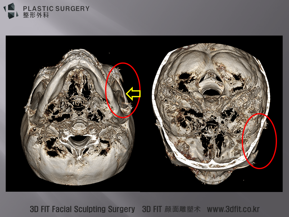 노란 화살표 부위는 환자가 통증을 호소하는 좌측 광대에서 Coronoid Process와 광대활이 무척 가까워져 있는 모습이 관찰 됩니다.