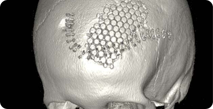 실제 삽입 환자의 모습은 위의 3D CT 와 같은 모습입니다.
