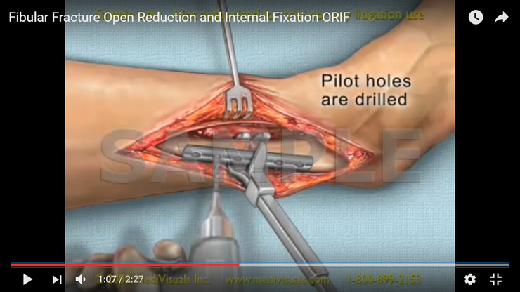 ORIF [open reduction internal fixation] : 네이버 블로그