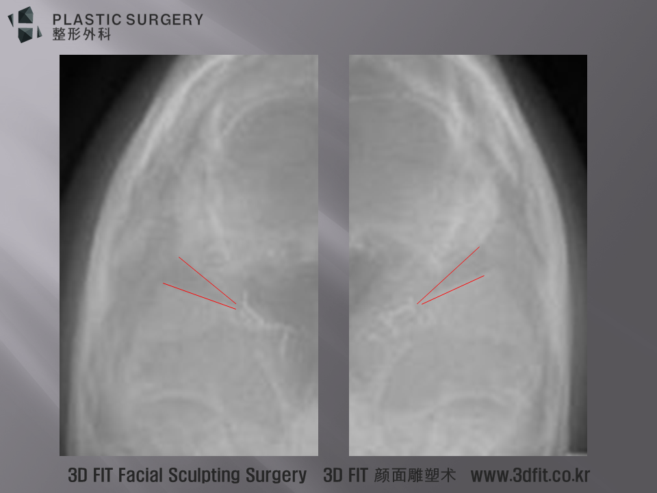그 부분만 자세히 보면, 위 사진의 빨간 선으로 표시된 모습 처럼 광대갭이 엑스레이 촬영시점 부터 있었다고 판단할 수 있습니다.