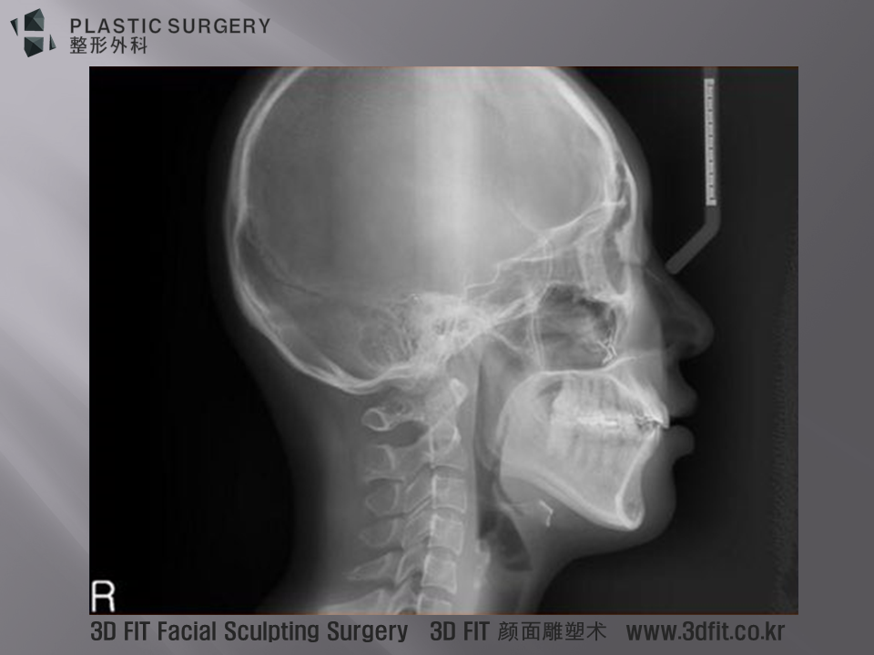 측면 엑스레이 역시 상악동의 상태와 고정된 금속을 확인할 수 있을뿐 광대 상태에 대한 정보는 얻을 수 없습니다.