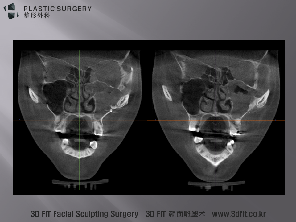 CT상의 Coronal View 라는 단면의 모습입니다. 상악동이 우측은 까맣게 보이는 반면, 좌측은 하얗게 무언가가 꽉차 있는 것으로 판단 됩니다. 수술 직후라면 피가 고였다고 판단하겠지만, 수술 후 2년반이 지난 경우이기에 상악동염으로 진단하는 것이 보다 합리적이라