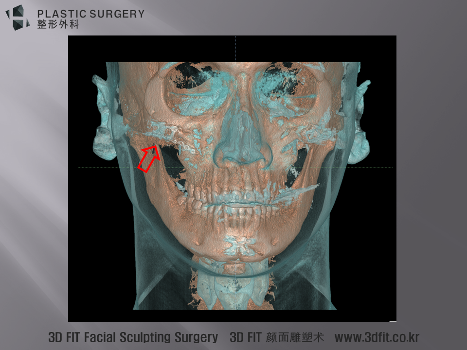 조금은 특이한 경우 입니다. 피하기종 (Subcutaneous Emphysema) 가 우측 광대상부에 관자놀이 부위에 발생한 경우 입니다.