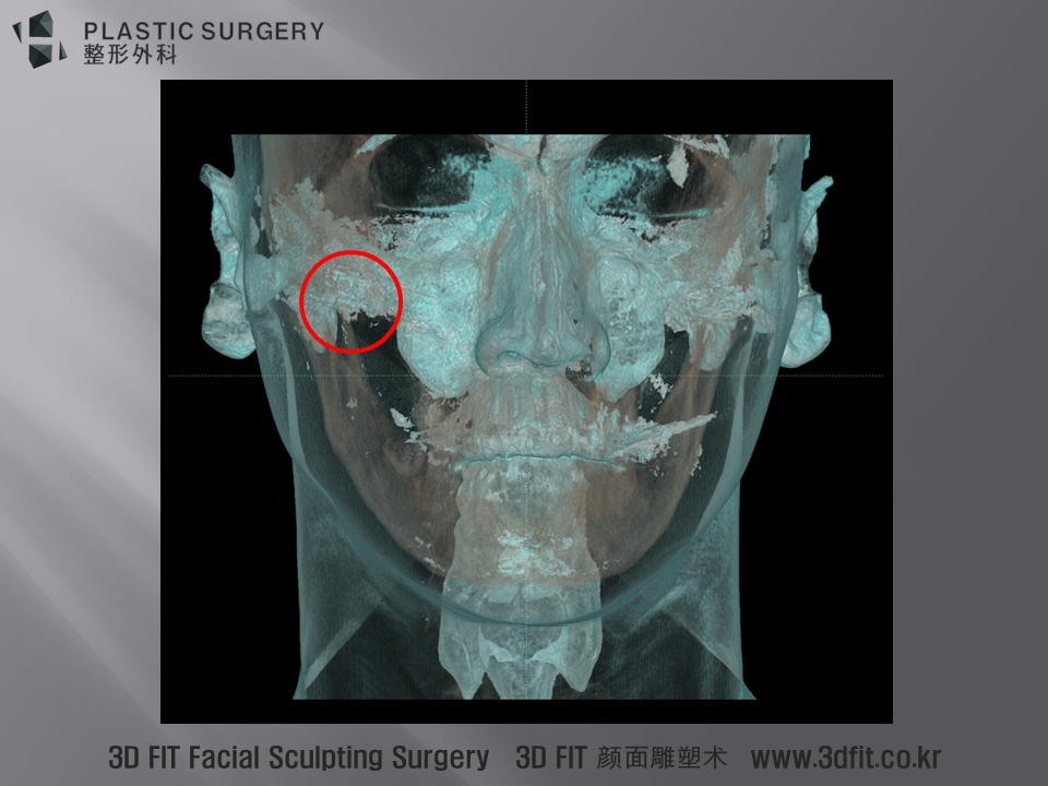 3D CT 에서 공기 음영을 강조해서 보면, 우측 아치상부에 정상적으로 존재하지 않아야할 공기 음영이 관찰 됩니다.