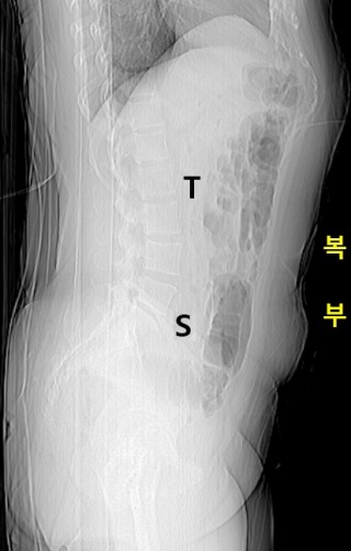대장내시경 술기 I. 대장의 해부학적 구조 : 네이버 블로그