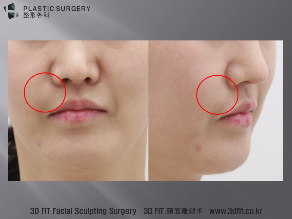심한 중안면부 함몰로 인해 큰 실리콘 보형물이 삽입되었고, 보형물이 입안 점막을 뚫고 나온 경우 입니다. 사진상의 빨간원 부위에서 보형물이 불룩하게 튀어 나온 모습이 관찰됩니다.
