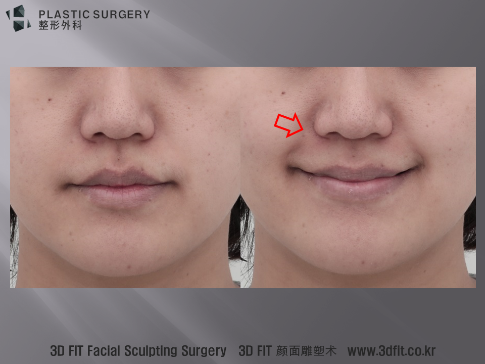 위 환자는 특징적으로 중안면부 함몰이 관찰되는 환자로 앞광대의 볼륨 부족 팔자주름 인중부위함몰 윗입술의 외번 (입술이 들린모습) 이 관찰됩니다. . 이러한 환자의 경우 미소지을때 팔자주름이 위 사진의 빨간 화살표 처럼 연결되지 못하고 끊어진 모습 관찰됩니다.