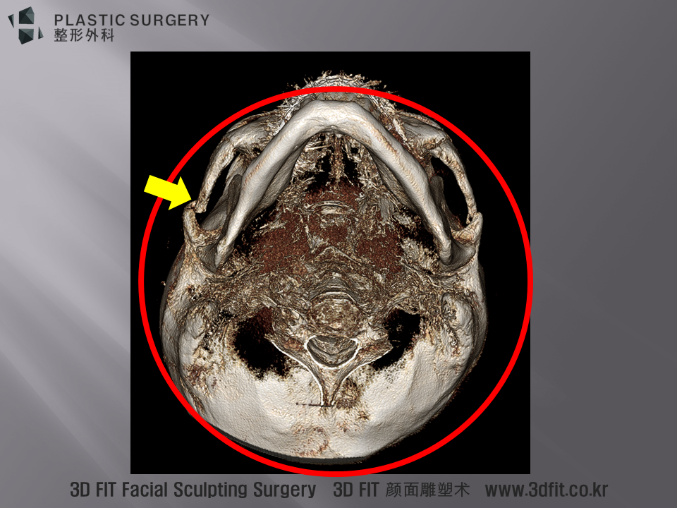 머리들고 있는 3D CT 이미지를 보시면 노란색 화살표 부위에서 아치절골라인이 앞쪽에 위치한 모습을 확인 할 수 있습니다. 빨간원의 의미는 동영상 참고 하시기 바랍니다. . 이러한 환자에서 재수술 계획시 가장 중요한 부분은