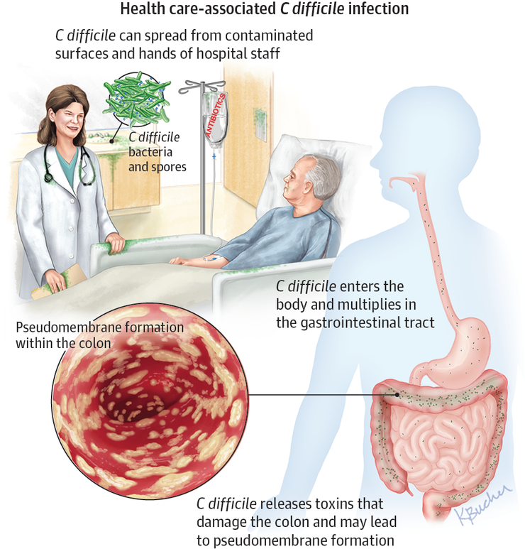  clostridium difficile infection cdi cdta