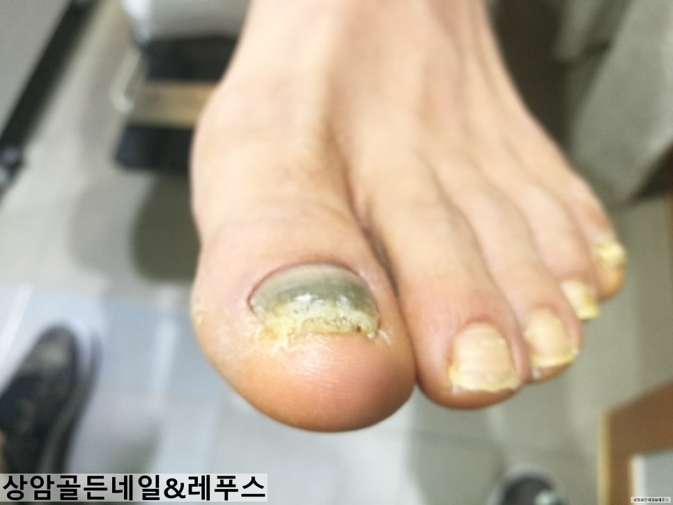골든네일&레푸스 이미지