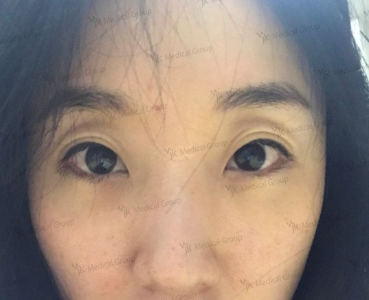 ภาพจมูกก่อนผ่าตัด