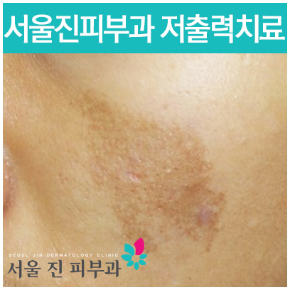 인지반점 이미지
