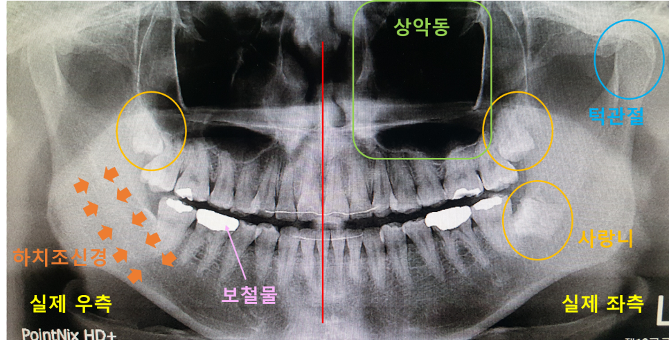 치과에서 촬영하는 엑스레이 ( x-ray ) 종류 :: 치과 방사선 사진 :: 파노라마 / CBCT 등 by 닥터자일리톨 ...