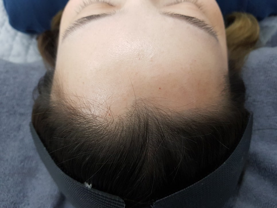 챠밍헤어라인 이미지