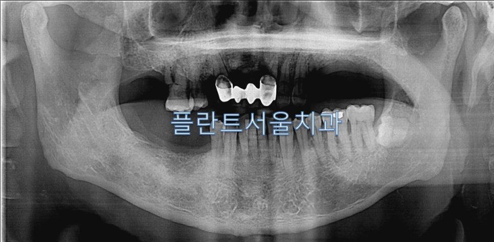 서울플란트치과 이미지