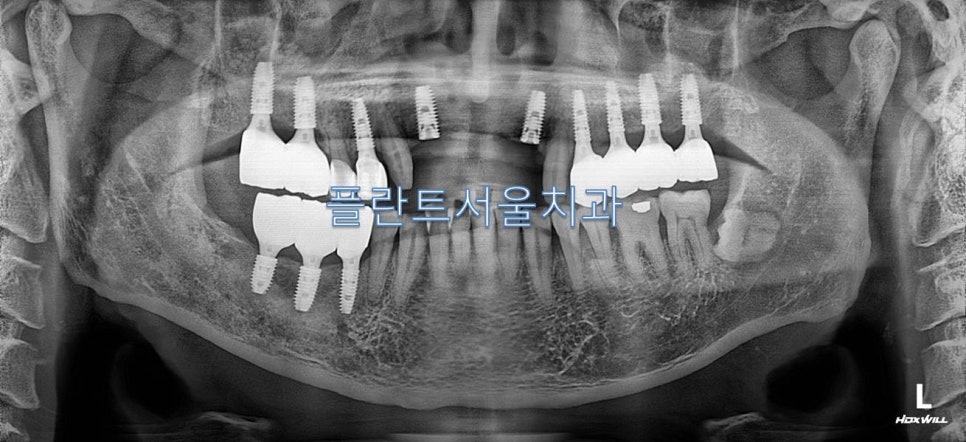 서울플란트치과 이미지