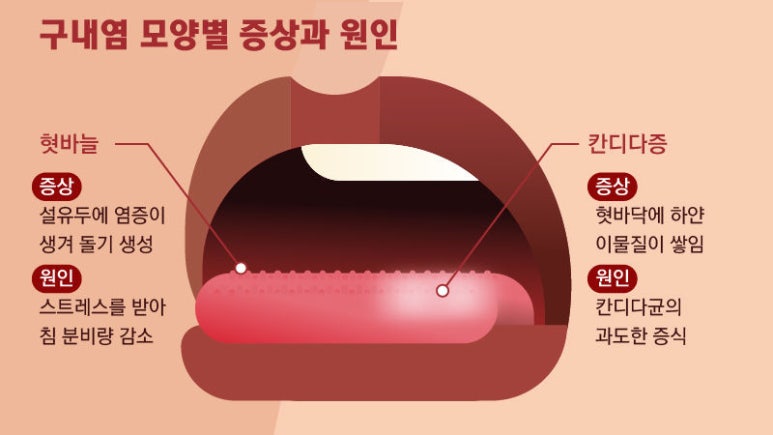 [약 정보] 구내염, 입병, 입안 상처 치료하기 : 네이버 블로그