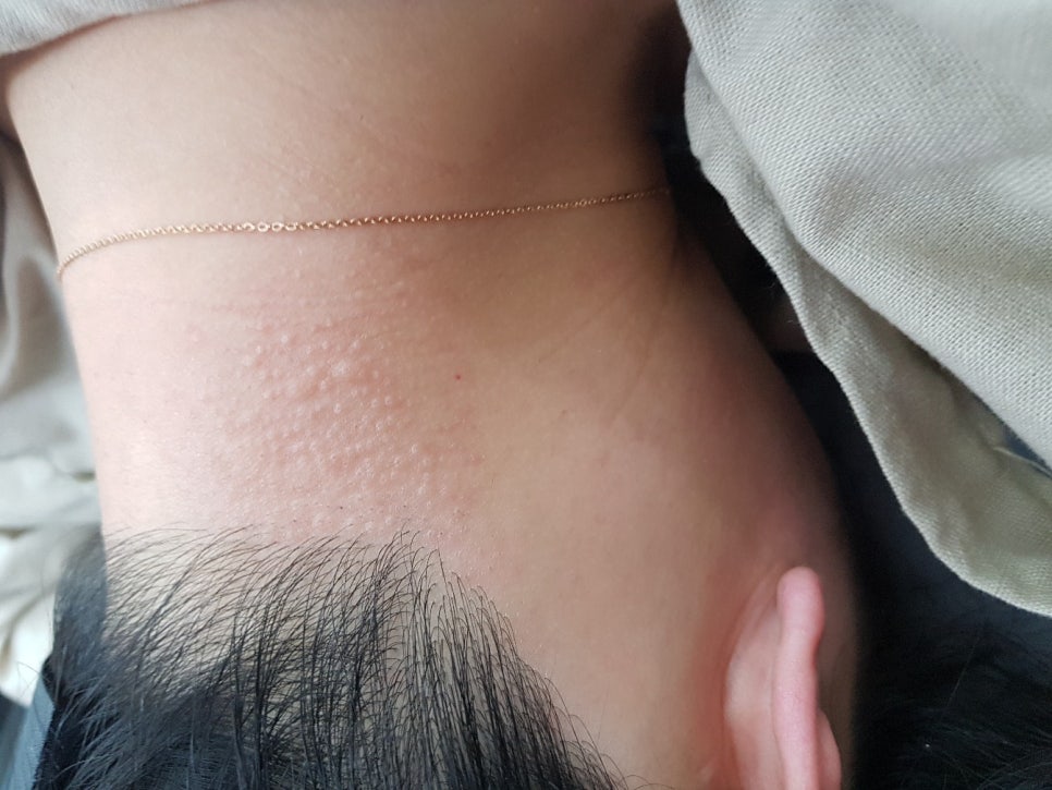 챠밍헤어라인 이미지