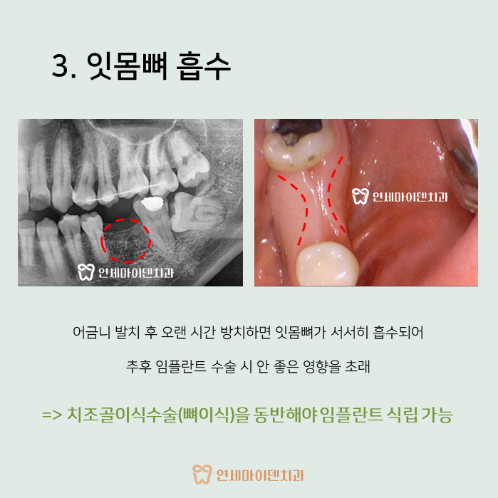 어금니 발치 후 방치하면 안 되나요? : 네이버 블로그