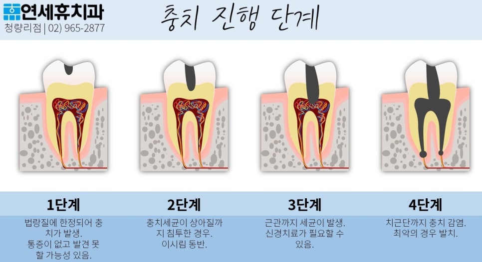 청량리보철치과 | 충치 그냥 두지 말고 치료하세요 : 네이버 블로그