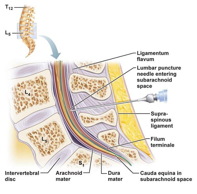 Lumbar puncture 요추천자/Lumbar puncture/요추천자/요추천자 자세/ 네이버 블로그