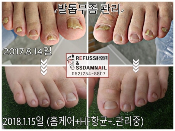 레푸스 이미지