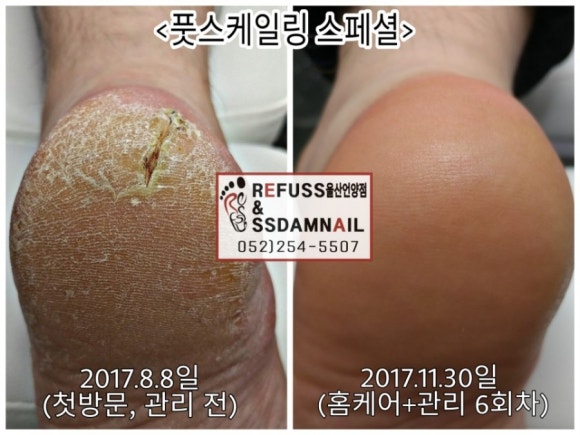 레푸스 이미지