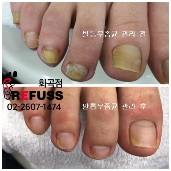 레푸스 이미지