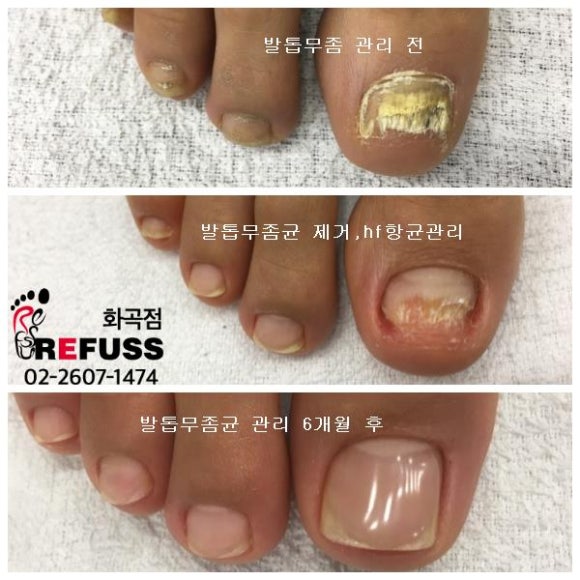 레푸스 이미지
