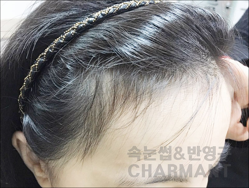 렉스헤어라인 이미지