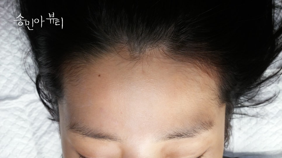 헤어라인 이미지