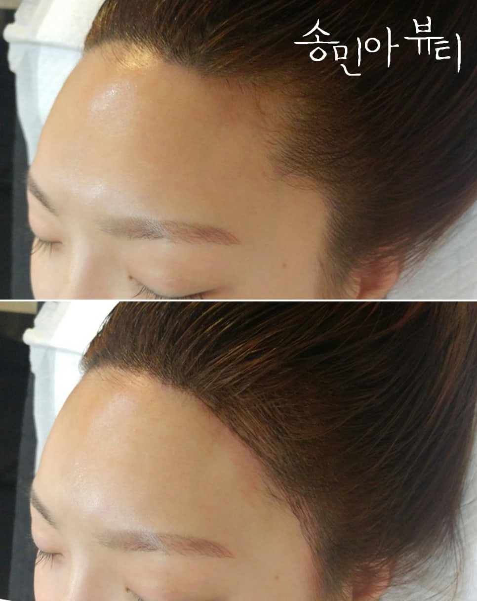 진헤어라인 이미지