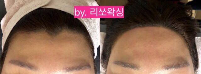 조헤어라인 이미지