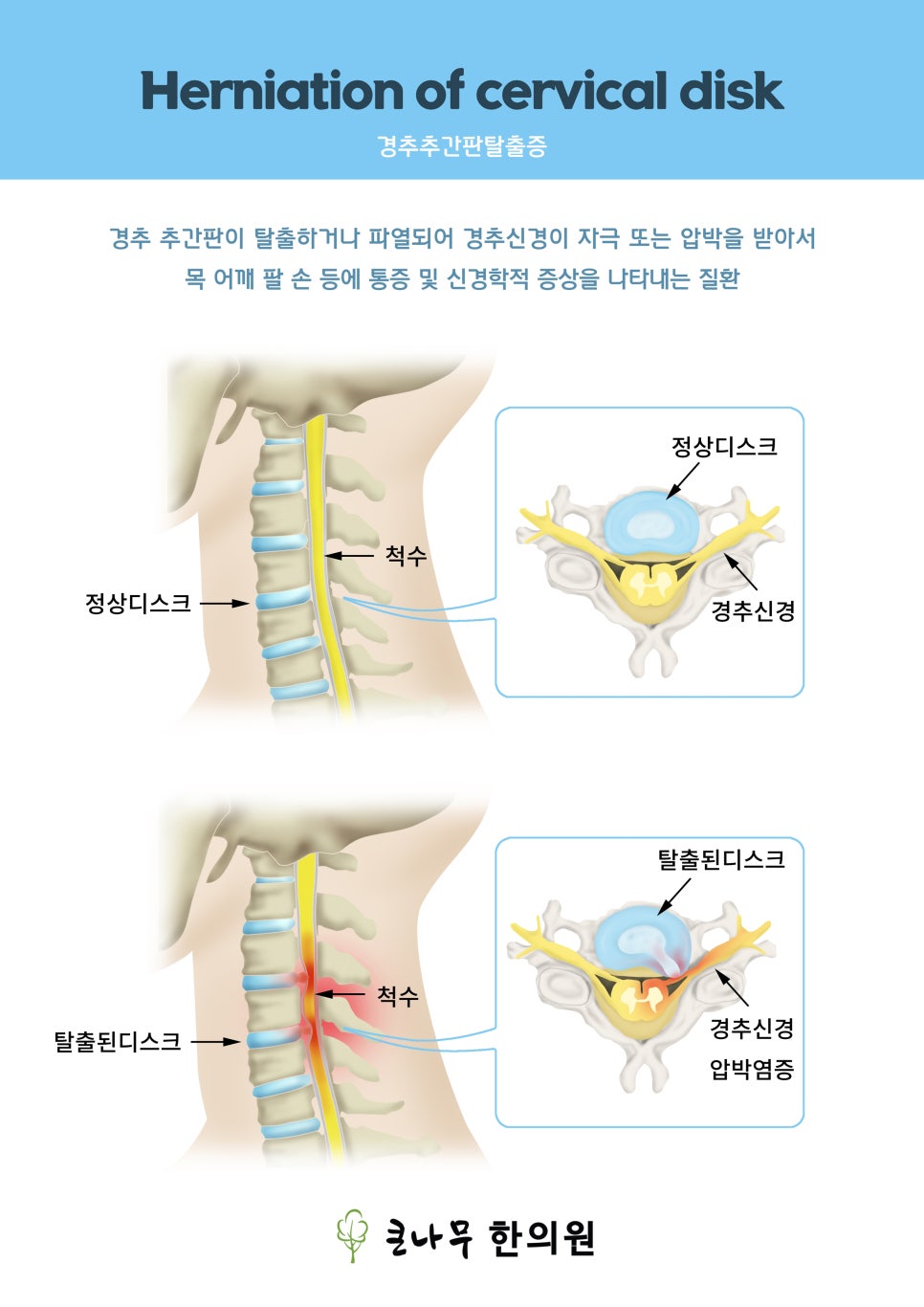 큰나무한의원 이미지
