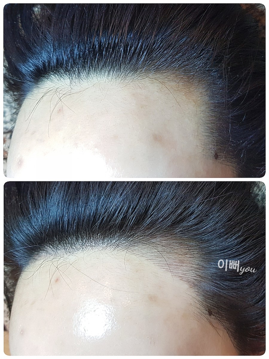 선헤어라인 이미지