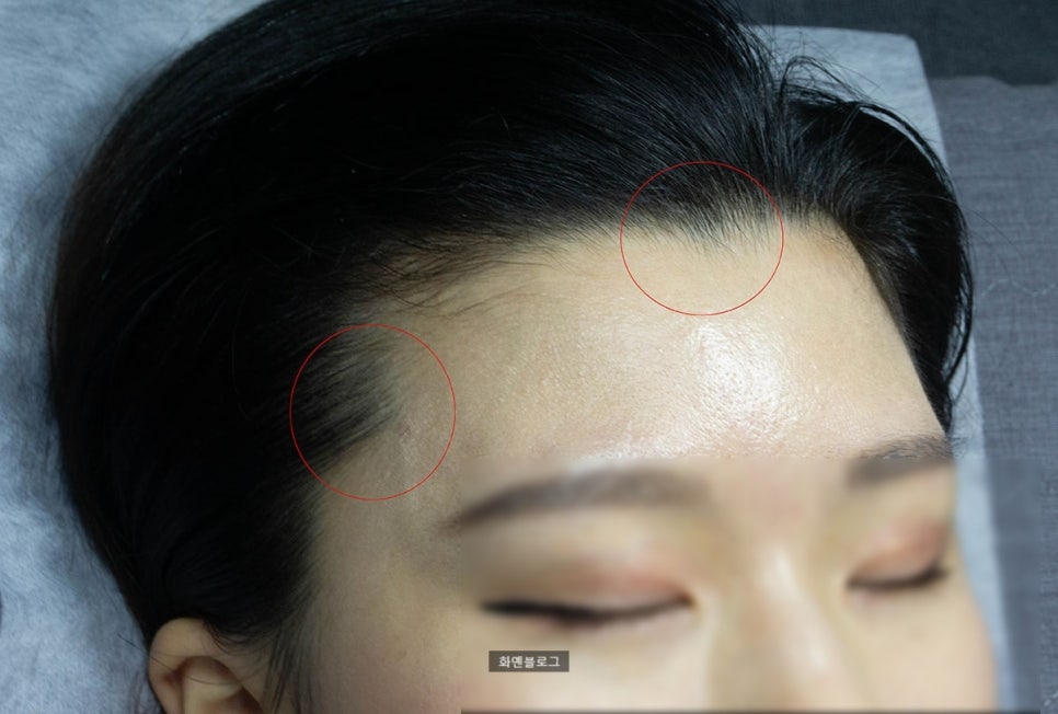 모모헤어라인 이미지