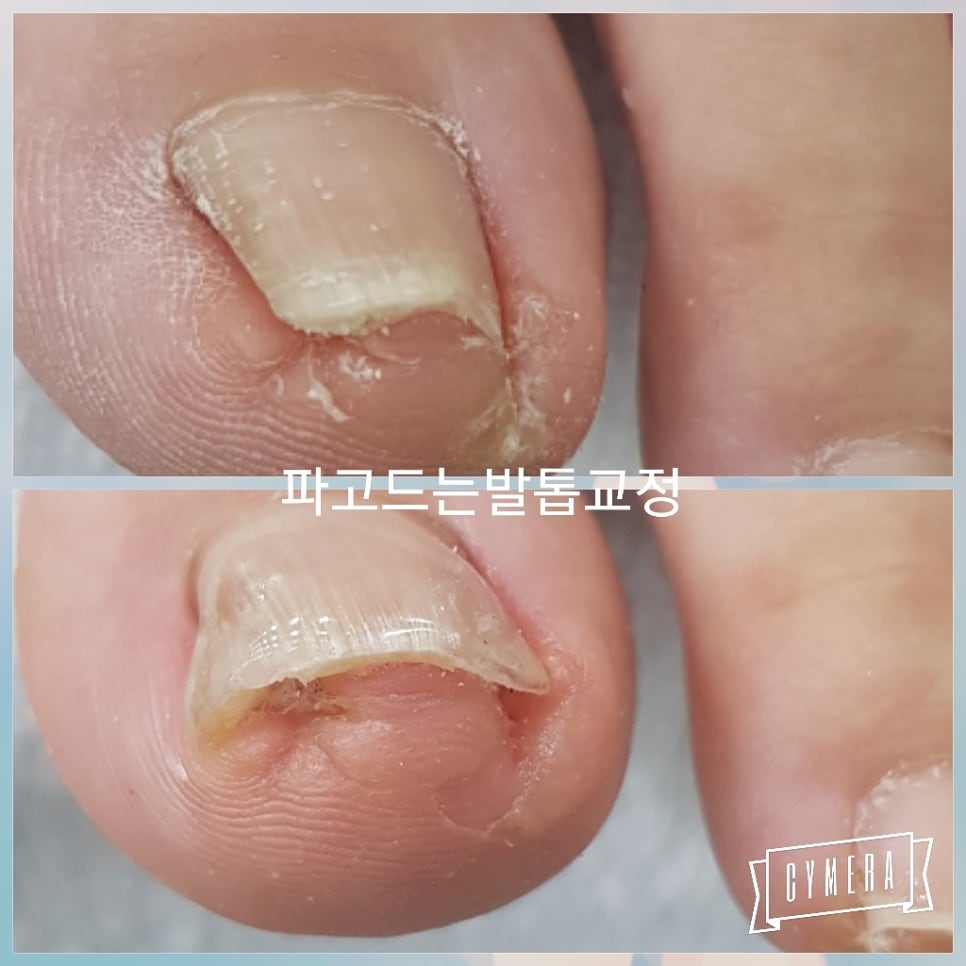 키스네일 이미지