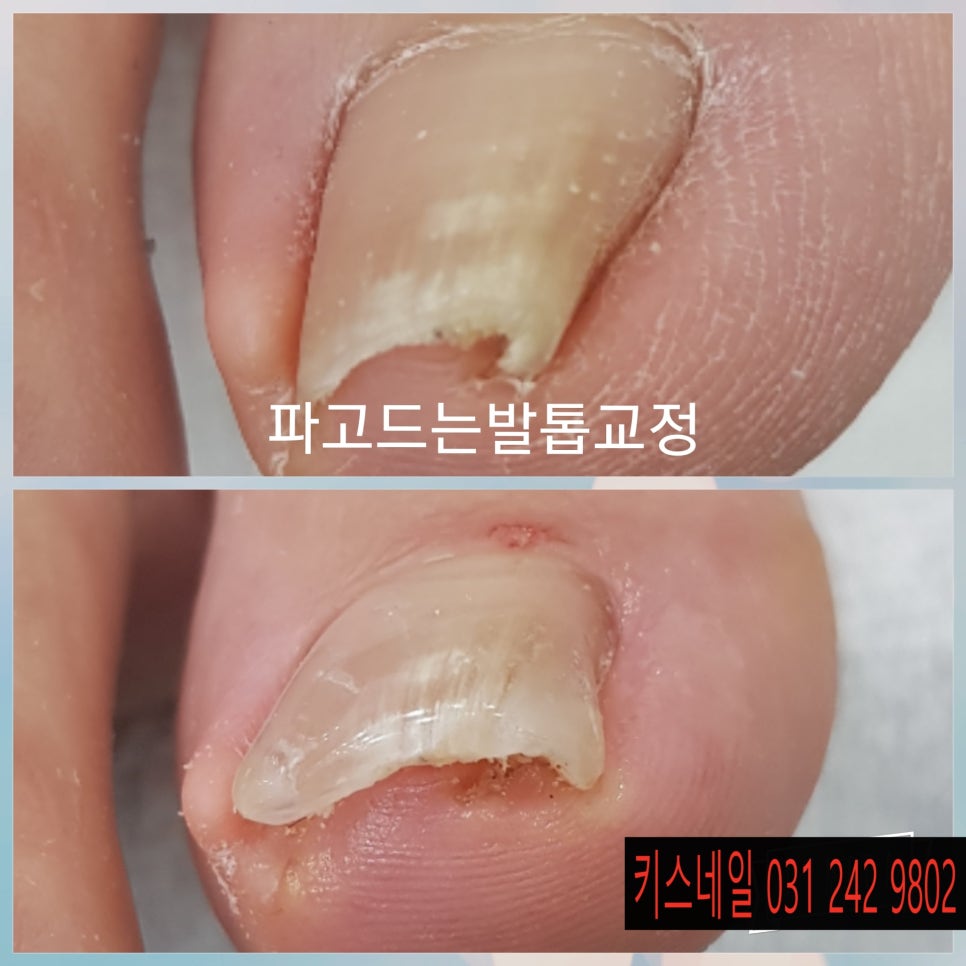 키스네일 이미지
