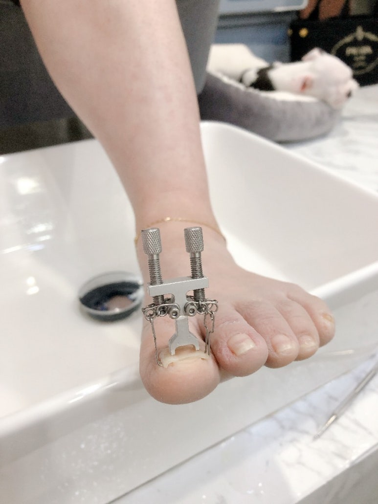곰팅이네일 이미지